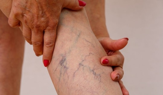 Các thuốc điều trị giãn tĩnh mạch chân