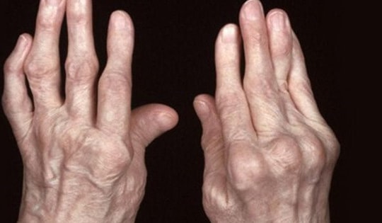 Các thuốc trị viêm khớp dạng thấp