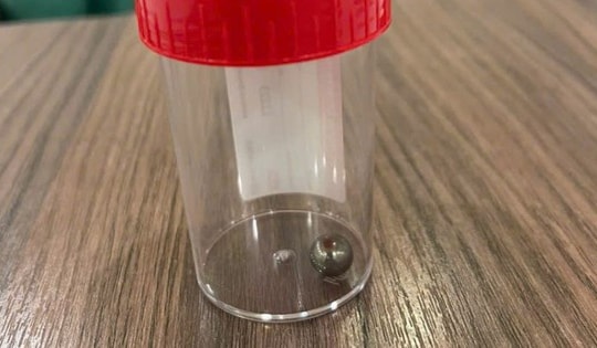 Nguy hiểm từ súng đồ chơi: Bé trai 5 tuổi vị viên bi bắn xuyên má, gãy xương mặt