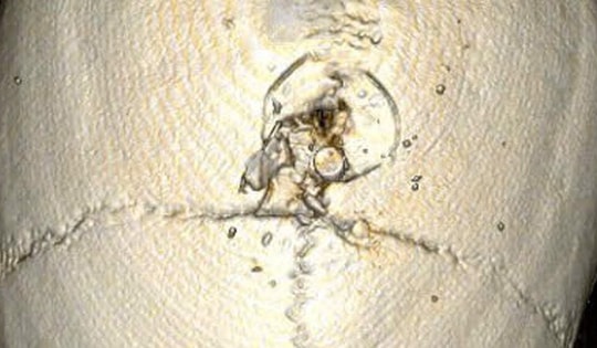 Hy hữu: Đau người, nhập viện mới biết hộp sọ bị đóng đinh