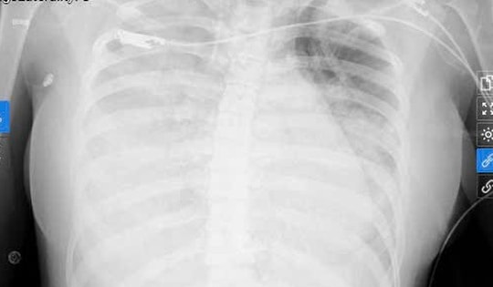 Chỉ với triệu chứng như cảm cúm, nữ sinh được phát hiện nhiễm liên cầu khuẩn nhóm A nguy kịch