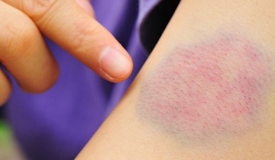 Thuốc điều trị xuất huyết giảm tiểu cầu