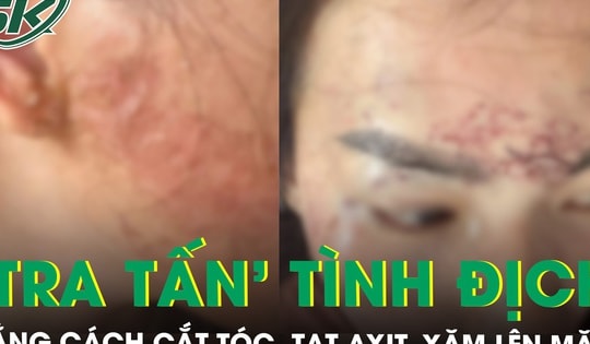 Công an vào cuộc vụ đánh ghen bằng cách cắt tóc, tạt axit, xăm lên mặt ‘tình địch’ ở Cà Mau