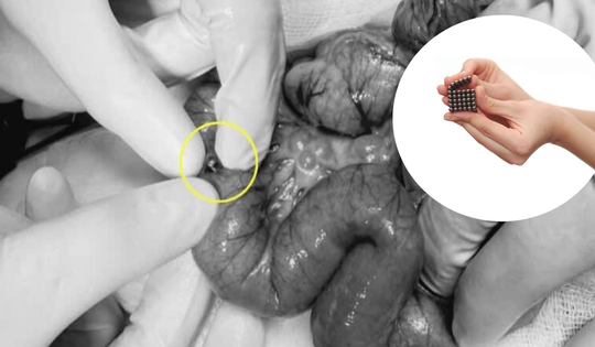 Bé 4 tuổi nuốt 20 viên nam châm, phải cắt bỏ 15cm ruột