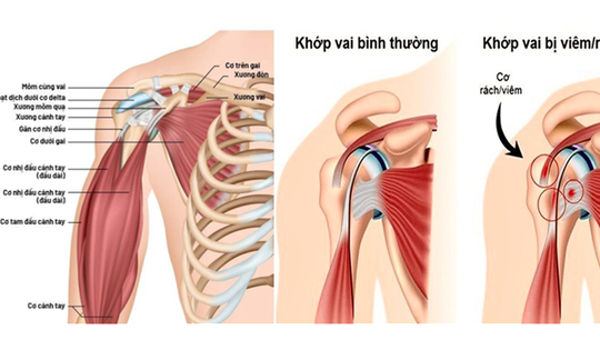 Một số thuốc dùng trị viêm quanh khớp vai