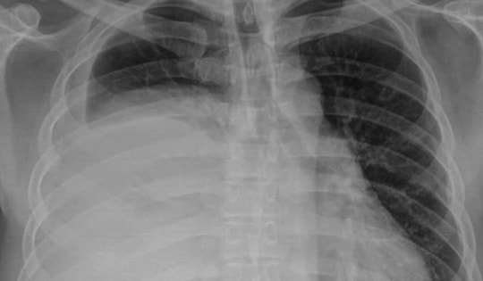 Người đàn ông 42 tuổi mang khối u nặng 3,6kg trong lồng ngực mà không biết