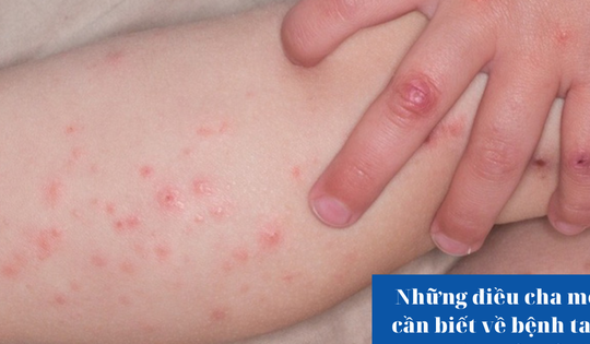 Những điều cha mẹ cần biết về bệnh tay chân miệng ở trẻ nhỏ
