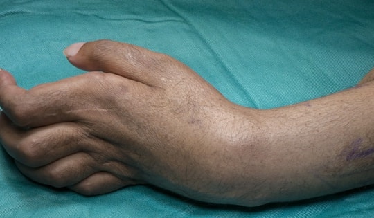 Thuốc dùng trong điều trị Hội chứng Volkmann