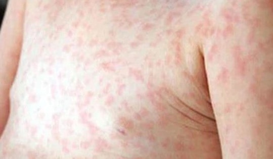 Xử lý triệt để các ổ dịch sốt xuất huyết ngay từ khi xuất hiện