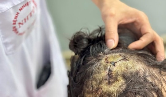 Thương tâm bé gái 5 tuổi bị chó nhà nặng hơn 20kg tấn công vào vùng đầu