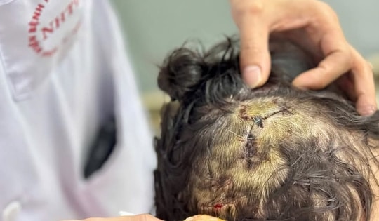 Chó 20 kg cắn rách đầu, mặt bé gái 5 tuổi ở Hà Nội