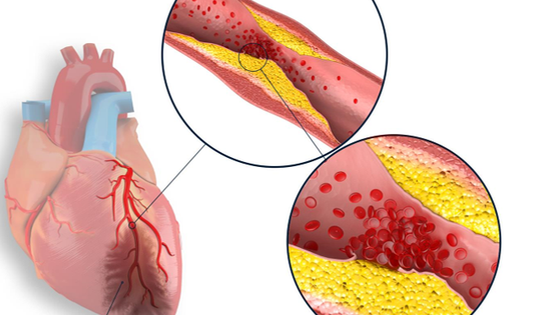 Cách phòng ngừa bệnh nhồi máu cơ tim cấp hiệu quả, người Việt tuyệt đối không bỏ qua
