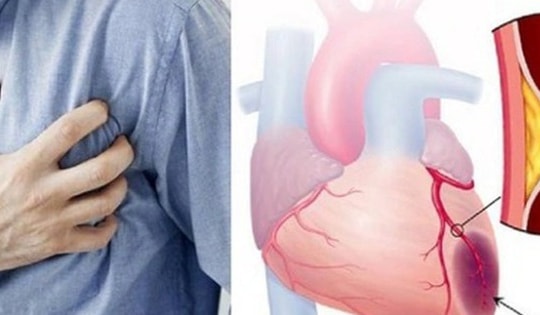 Người đàn ông ở Vĩnh Phúc 2 lần ngừng tim do nhồi máu cơ tim cấp từ dấu hiệu nhiều người Việt bỏ qua