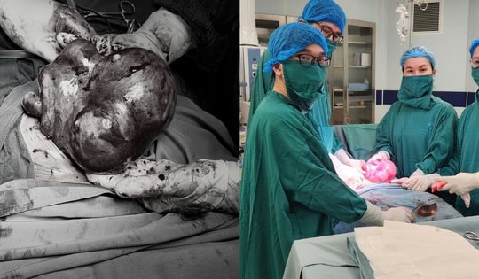 Người phụ nữ 45 tuổi ở Phú Thọ phát hiện u xơ tử cung to nhanh bất thường, thừa nhận một sai lầm nhiều chị em Việt mắc phải