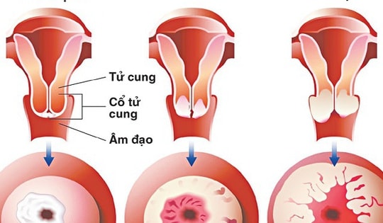 Chị em cần biết điều này trước khi làm tầm soát ung thư cổ tử cung