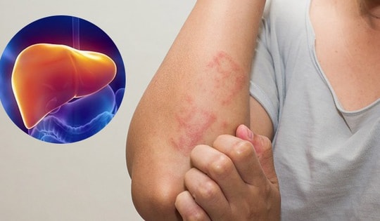 Mùa hè nắng nóng, khi nào nên thải độc gan, đây là 3 nhóm người cần cảnh giác