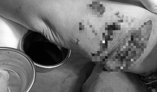 Cụ bà 77 tuổi bị đàn chó cắn, bác sĩ mất nhiều giờ để xử lý vết thương
