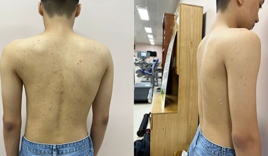 Tin vui cho trẻ mắc bệnh lý gù, vẹo cột sống