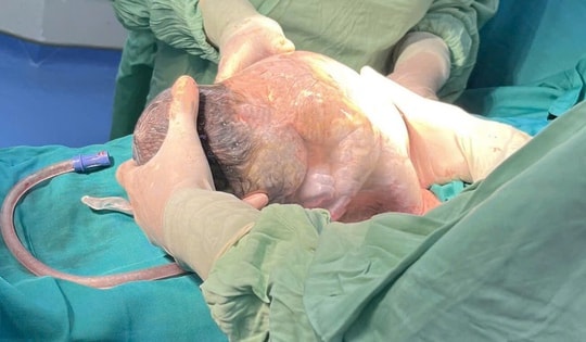 Ca sinh mổ hiếm gặp với tỉ lệ chỉ 1/80.000 ca