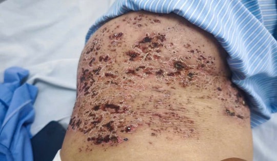 Người phụ nữ 73 tuổi nhập viện trong tình trạng đau đớn, tổn thương da nặng do sai lầm trong điều trị zona thần kinh nhiều người Việt mắc phải