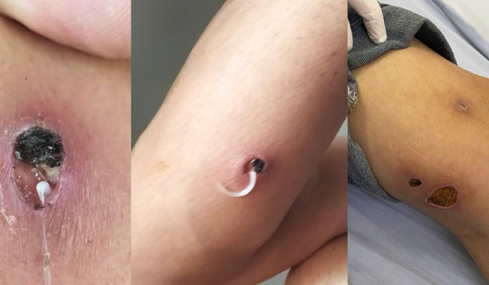 Cảnh báo căn bệnh hiếm gặp xuất hiện ở Việt Nam