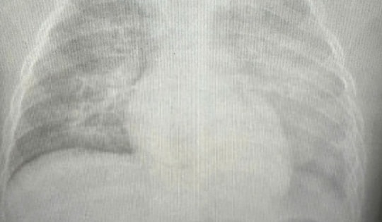 Bé gái 8 tuổi sốc nhiễm trùng, suy gan, phổi trắng xóa sau 6 giờ nhập viện