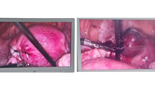 Cứu sống sản phụ mang song thai ngoài tử cung, sốc mất máu