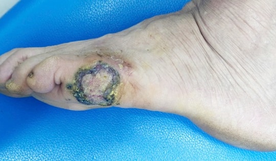 Nốt ruồi ở bàn chân không ngờ ung thư da