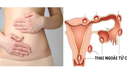 Người phụ nữ 36 tuổi nhập viện vì thai ngoài tử cung vỡ, thừa nhận một sai lầm nhiều phụ nữ Việt mắc phải