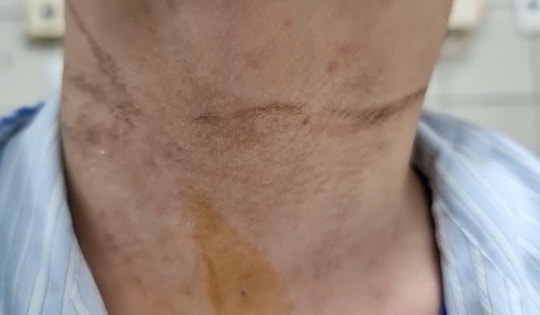 Bé trai nhập viện khẩn do nghịch dây rút quần, khuyến cáo những điều bố mẹ nên biết để bảo vệ con trong dịp nghỉ hè