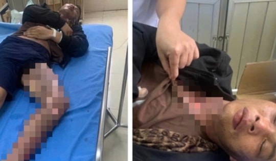 Leo trạm biến áp cắt trộm dây điện, hai người bị điện giật bỏng nặng