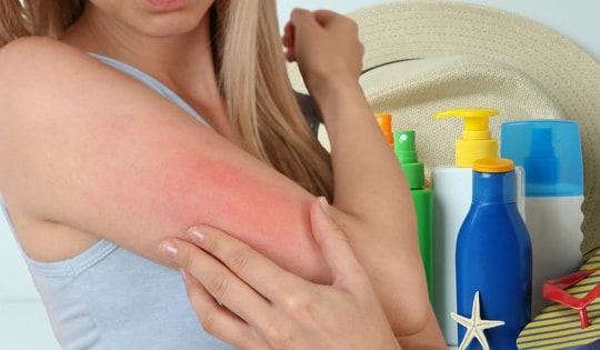 Cách xử trí khi bị dị ứng kem chống nắng