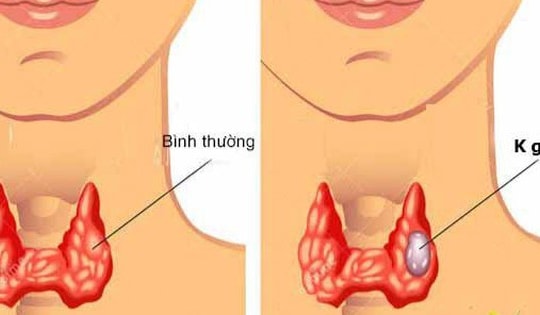 Người phụ nữ 60 tuổi cùng lúc mắc 2 thể ung thư tuyến giáp thừa nhận sai lầm nhiều người Việt mắc phải