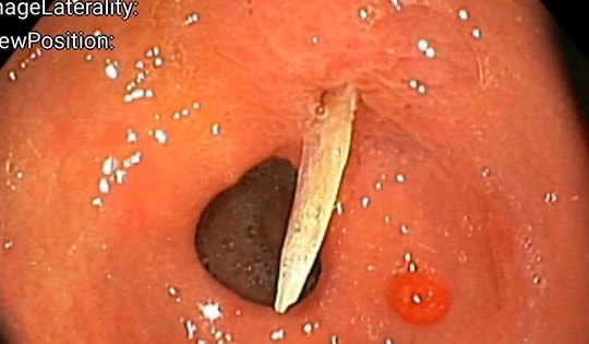 Cứu sống cụ bà bị dị vật đâm vào trong ổ bụng