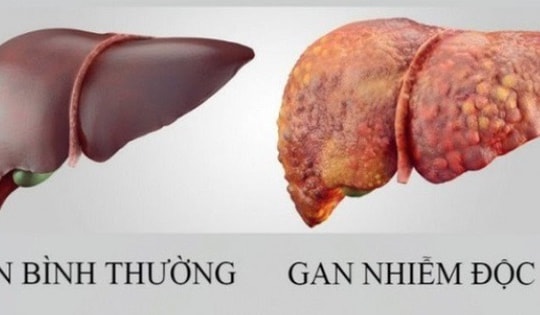 Loại quả mùa hè rẻ tiền, ngọt mát giúp làm mát gan, người Việt dùng vào thời điểm này để giúp gan thải độc