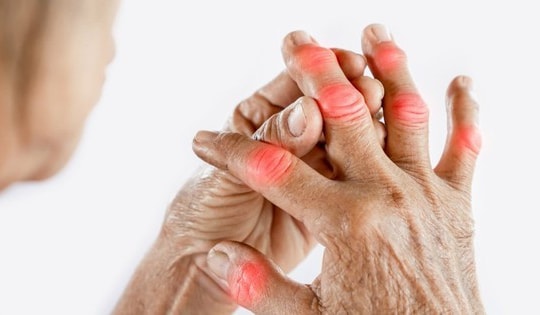 Biểu hiện cảnh báo khởi phát bệnh gút