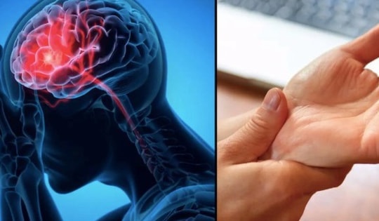 Cô gái 21 tuổi nguy kịch nhập viện vì đột quỵ, xuất huyết não, bác sĩ chỉ rõ nguyên nhân chính