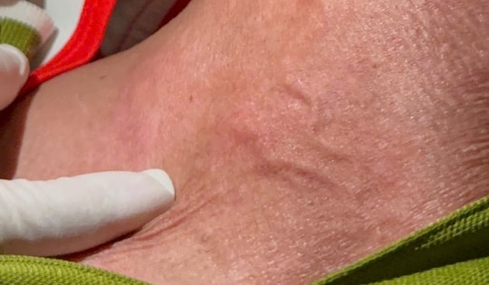 Việt Nam ghi nhận ca mắc giun rồng 26, bác sĩ chỉ cách phát hiện sớm