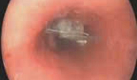 Sơ ý uống luôn vỏ thuốc, bệnh nhân được nội soi khẩn cấp tại Bệnh viện Thuận Mỹ ITO Đồng Nai