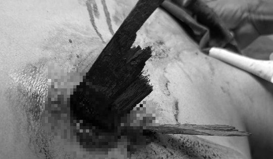 Cứu sống ngoạn mục nam thanh niên bị thanh gỗ đâm thấu ngực