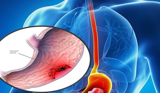 Phát hiện ung thư từ dấu hiệu chóng mặt