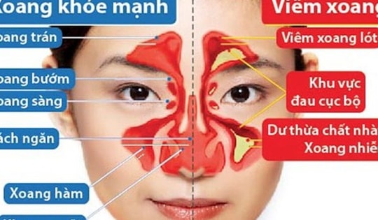Cảnh báo nguy cơ viêm mũi xoang cấp từ một sai lầm nhiều người Việt mắc phải