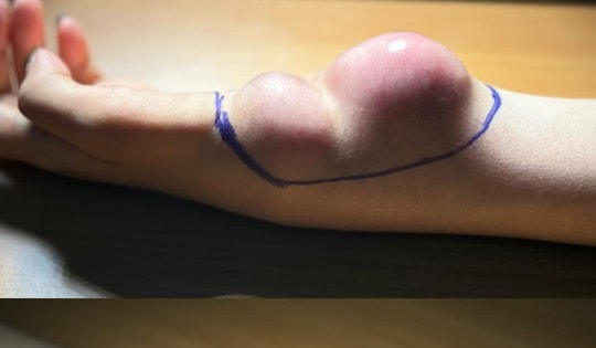 Đau cổ tay kéo dài, cô gái 23 tuổi bất ngờ phát hiện mắc ung thư