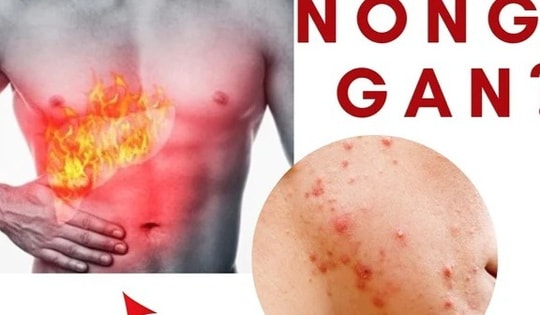 Mùa hè, 4 dấu hiệu cơ thể cảnh báo bạn đang bị nóng gan