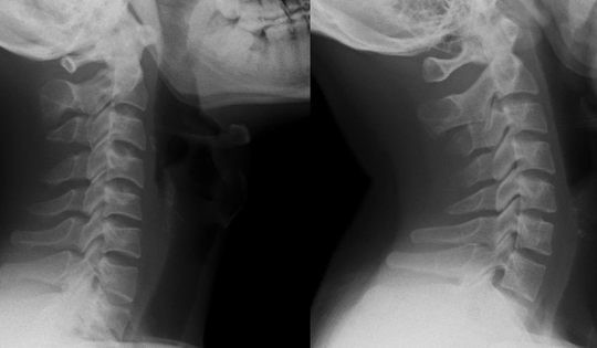 Nam thanh niên 26 tuổi cột sống cổ 'thẳng tưng' vì thói quen hàng triệu người Việt mắc phải