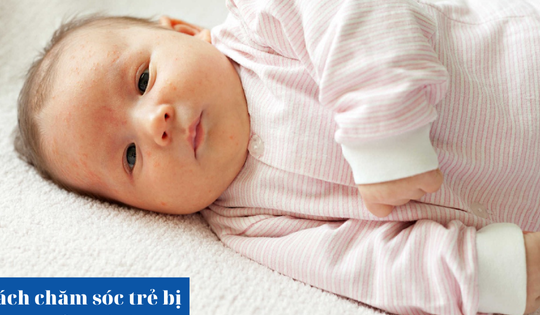 Cách chăm sóc trẻ bị rôm sảy tại nhà