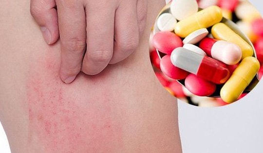 Thuốc dị ứng có an toàn khi dùng mỗi ngày?