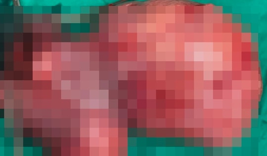 Phẫu thuật khối u xơ tử cung nặng gần 4kg cho người phụ nữ 41 tuổi ở Hà Nội