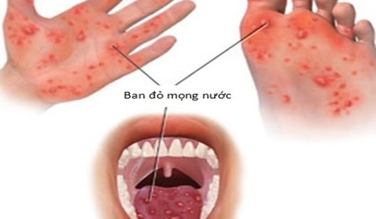 Bệnh tay chân miệng đang gia tăng, bố mẹ cần biết điều này để bảo vệ con