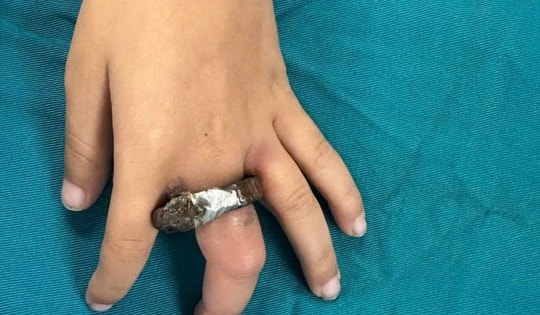 Vòng khóa siết ngón tay bé trai, gia đình cưa cửa mang đến viện